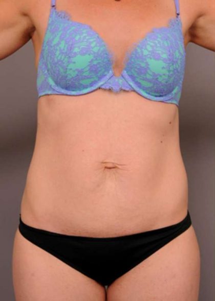 Tummy Tuck Before & After Patient #329