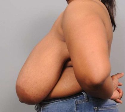 Breast Reduction Before & After Patient #1293