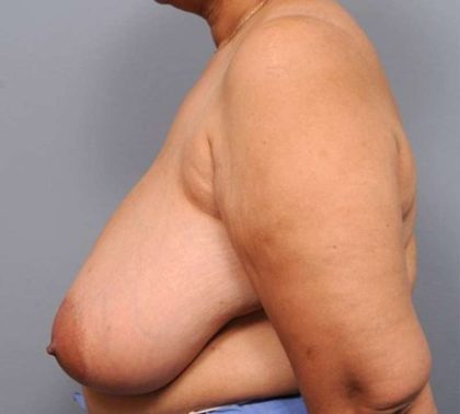 Breast Reduction Before & After Patient #1303
