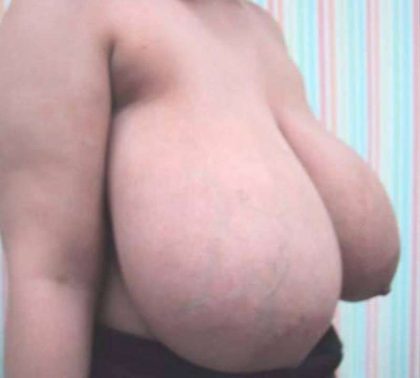 Breast Reduction Before & After Patient #1320
