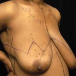 Breast Reduction Before & After Patient #1343