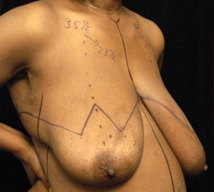Breast Reduction Before & After Patient #1343
