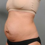Tummy Tuck Before & After Patient #338