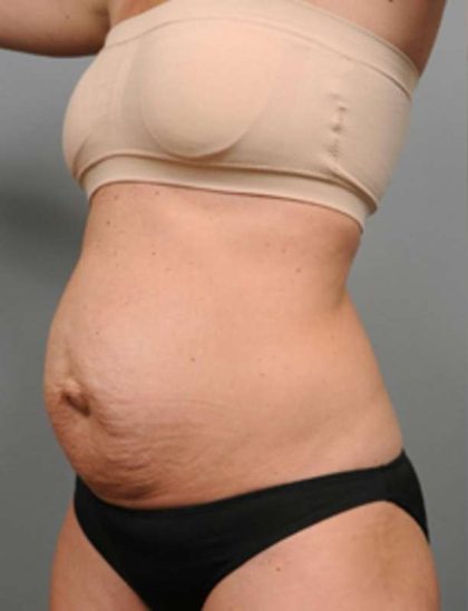 Tummy Tuck Before & After Patient #338