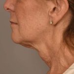 Facelift Before & After Patient #1359