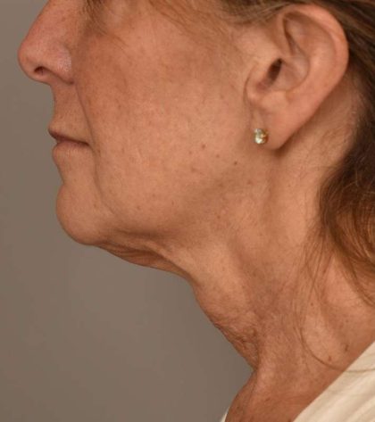 Facelift Before & After Patient #1359