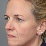 Facelift Before & After Patient #1371