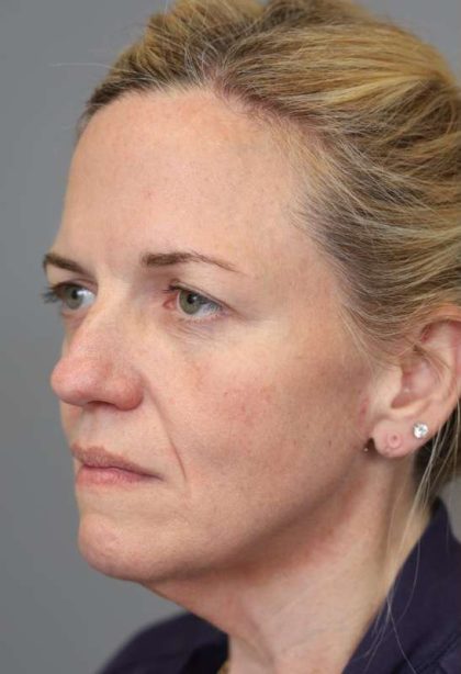 Facelift Before & After Patient #1371
