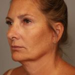 Facelift Before & After Patient #1380