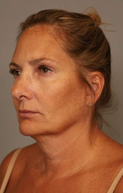 Facelift Before & After Patient #1380