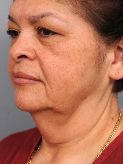 Facelift Before & After Patient #1399