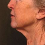 Facelift Before & After Patient #1404