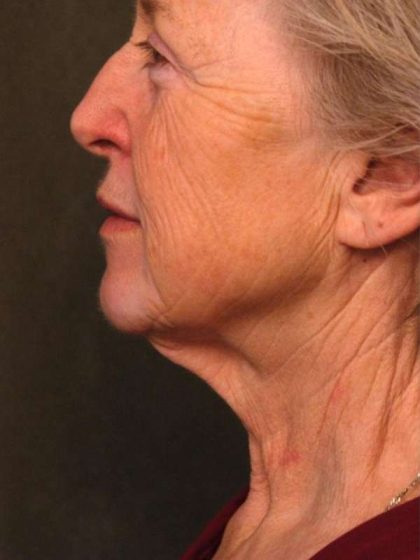 Facelift Before & After Patient #1404