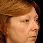 Facelift Before & After Patient #1411