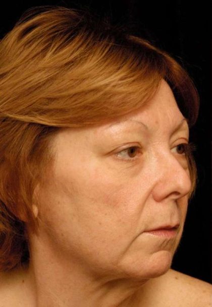 Facelift Before & After Patient #1411