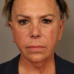 Facelift Before & After Patient #1418