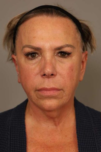 Facelift Before & After Patient #1418