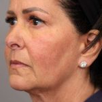 Facelift Before & After Patient #1427
