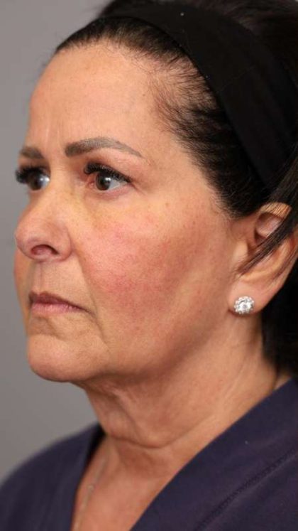 Facelift Before & After Patient #1427
