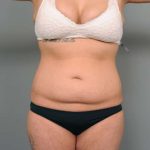 Tummy Tuck Before & After Patient #345
