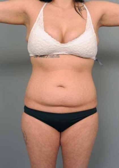 Tummy Tuck Before & After Patient #345
