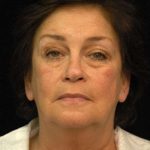 Facelift Before & After Patient #1443