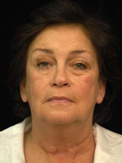 Facelift Before & After Patient #1443