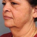 Naturalift&trade; Mini Facelift Before & After Patient #1452