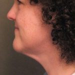 Naturalift&trade; Mini Facelift Before & After Patient #1457