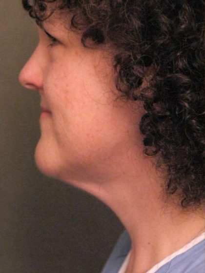 Naturalift™ Mini Facelift Before & After Patient #1457