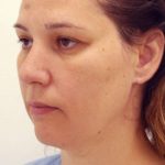 Naturalift&trade; Mini Facelift Before & After Patient #1464