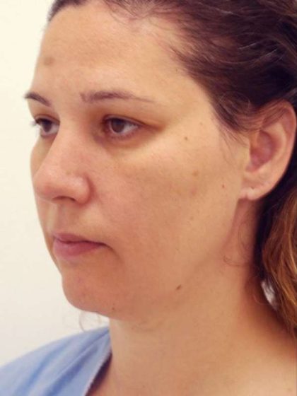 Naturalift™ Mini Facelift Before & After Patient #1464