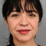 Naturalift&trade; Mini Facelift Before & After Patient #1474