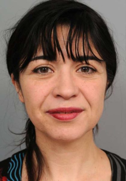 Naturalift™ Mini Facelift Before & After Patient #1474