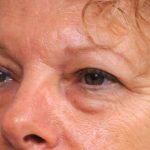 Eyelid Surgery Before & After Patient #1481