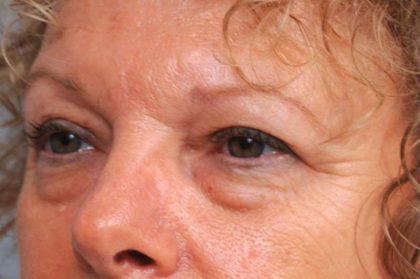 Eyelid Surgery Before & After Patient #1481