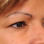 Eyelid Surgery Before & After Patient #1490