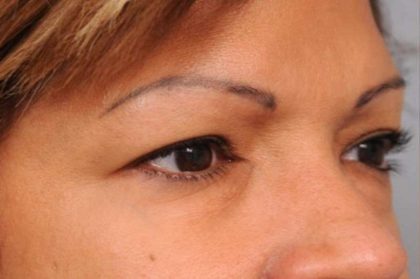 Eyelid Surgery Before & After Patient #1490