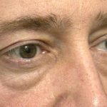 Eyelid Surgery Before & After Patient #1495