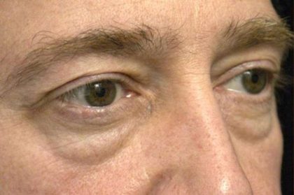 Eyelid Surgery Before & After Patient #1495