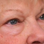 Eyelid Surgery Before & After Patient #1504