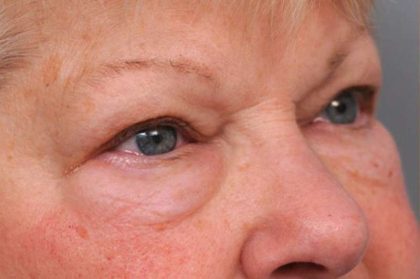 Eyelid Surgery Before & After Patient #1504