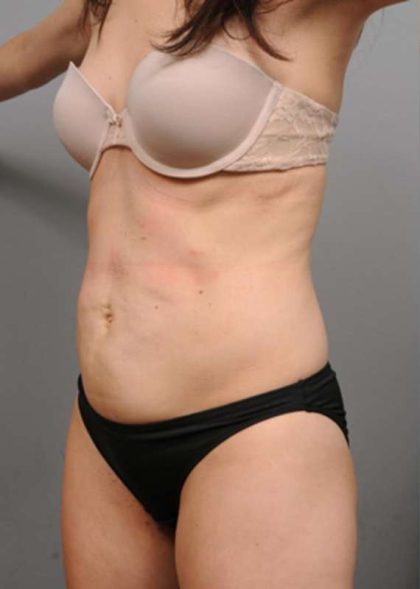 Tummy Tuck Before & After Patient #354