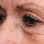 Eyelid Surgery Before & After Patient #1509