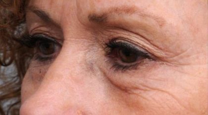 Eyelid Surgery Before & After Patient #1509