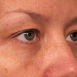 Eyelid Surgery Before & After Patient #1514