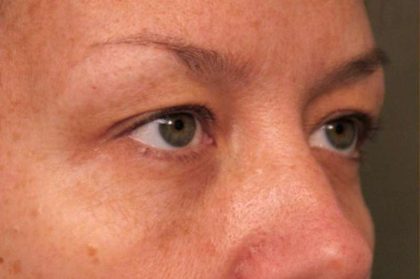 Eyelid Surgery Before & After Patient #1514