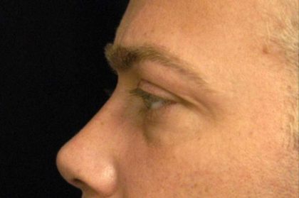 Eyelid Surgery Before & After Patient #1519