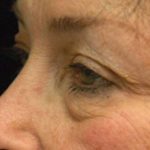 Eyelid Surgery Before & After Patient #1525