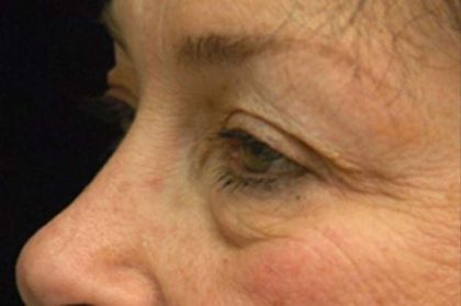 Eyelid Surgery Before & After Patient #1525